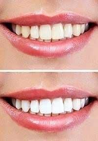 Teeth Whitening Special Coopers Plains Dentist