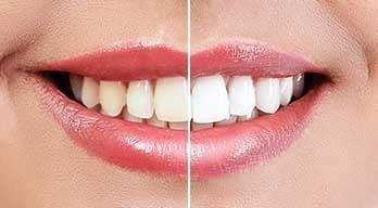 Teeth Whitening Special Coopers Plains Dentist